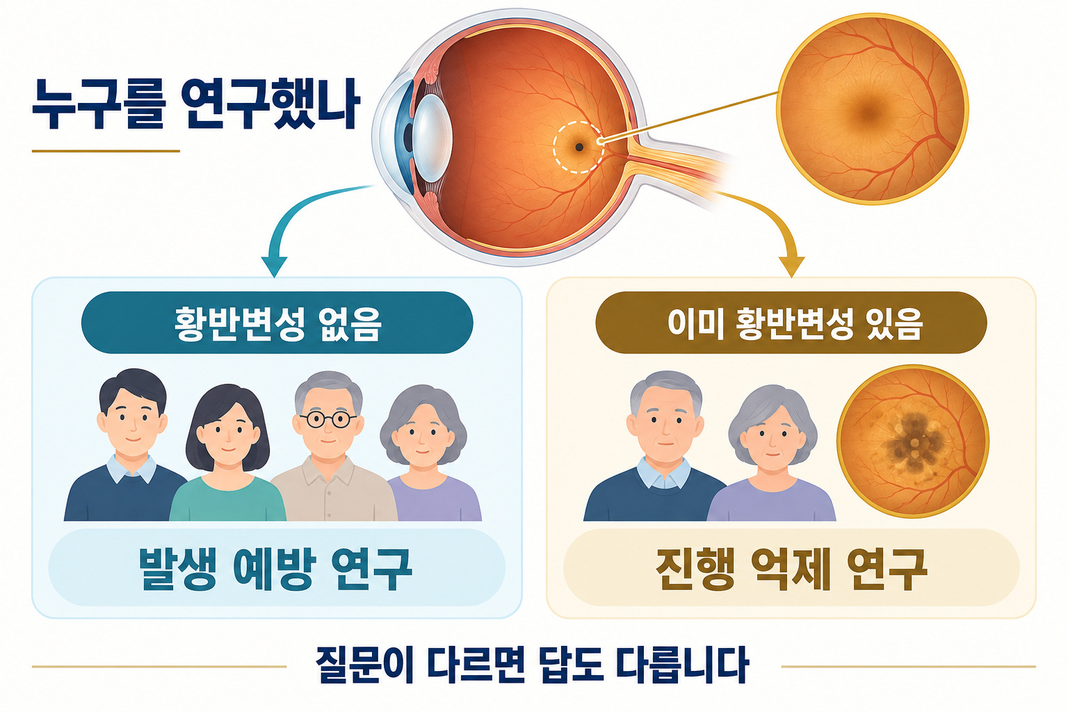 황반변성이 없는 사람의 발생 예방 연구와 이미 황반변성이 있는 사람의 진행 억제 연구를 구분한 도해