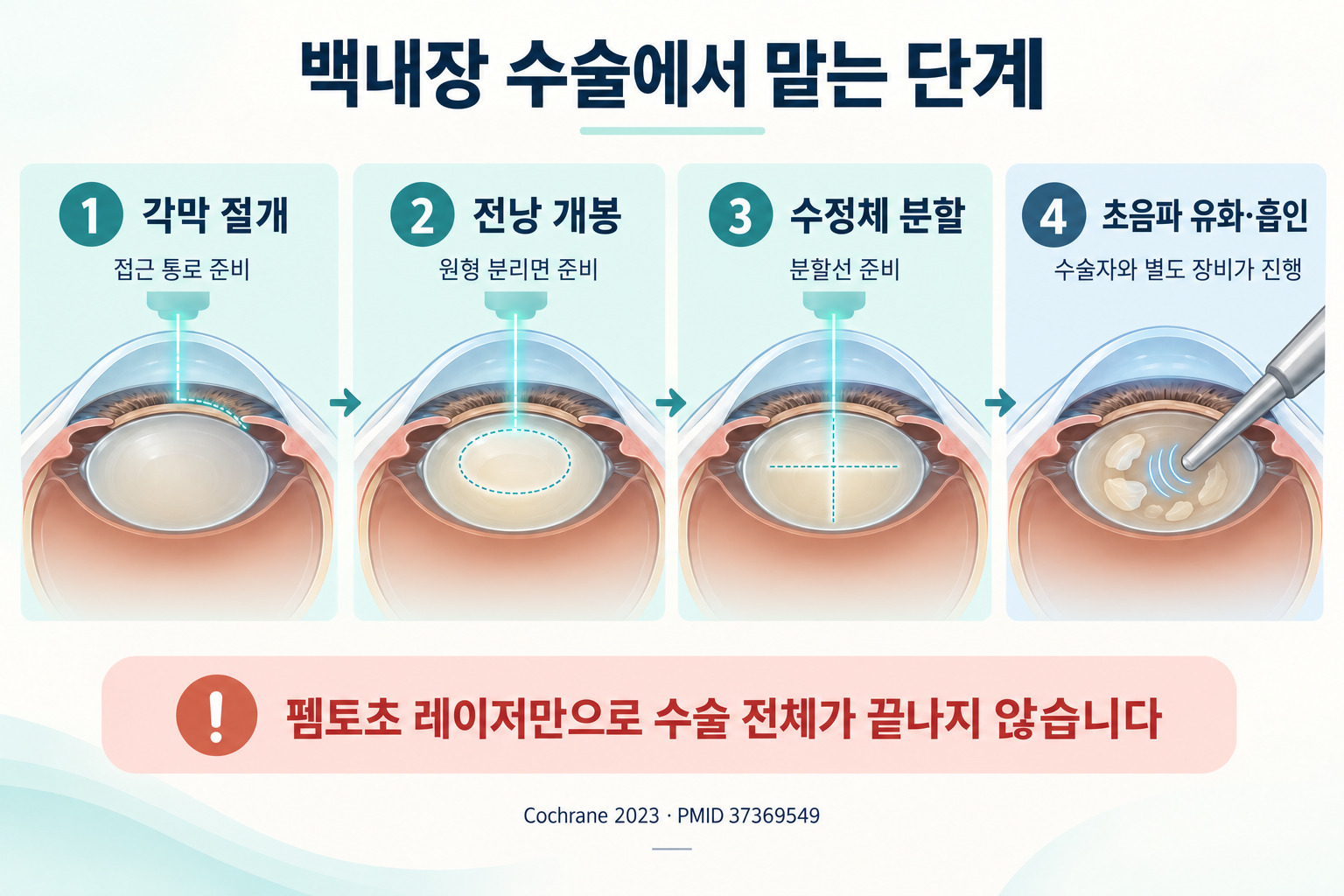 펨토초 보조 백내장 수술의 각막 절개, 전낭 개봉, 수정체 분할과 초음파 유화·흡인 단계