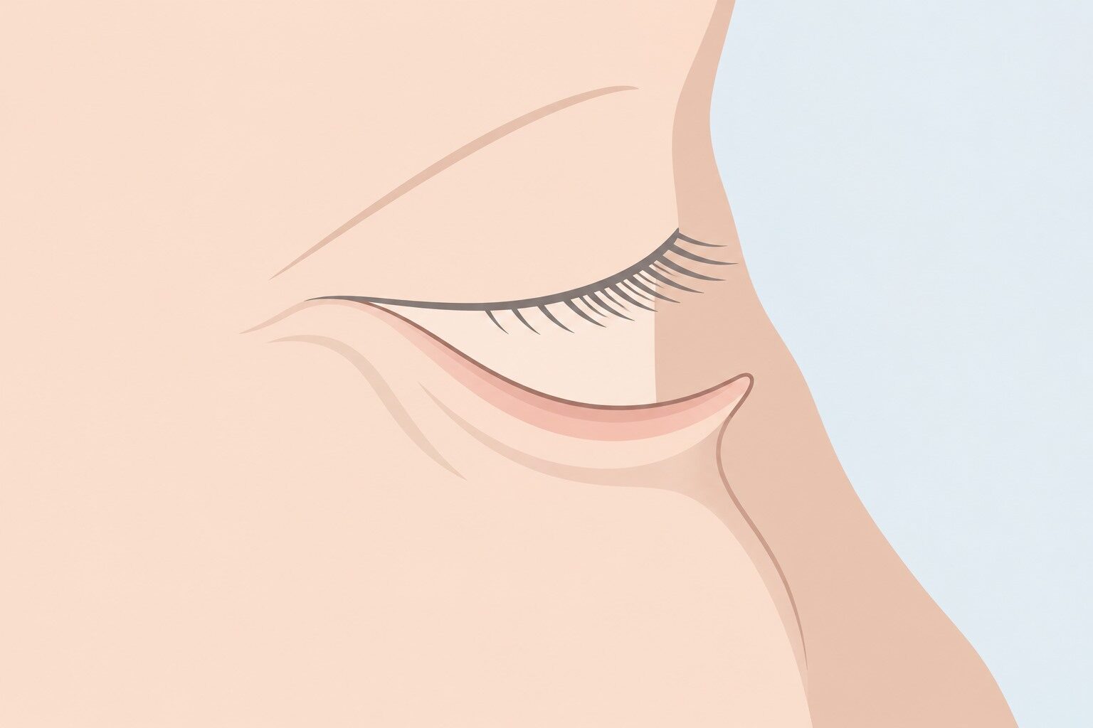 눈꺼풀 바깥말림(안검외반) — 아래 눈꺼풀이 처져 빨간 속살이 보일 때 대표 이미지